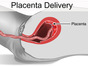 Placenta_Delivery